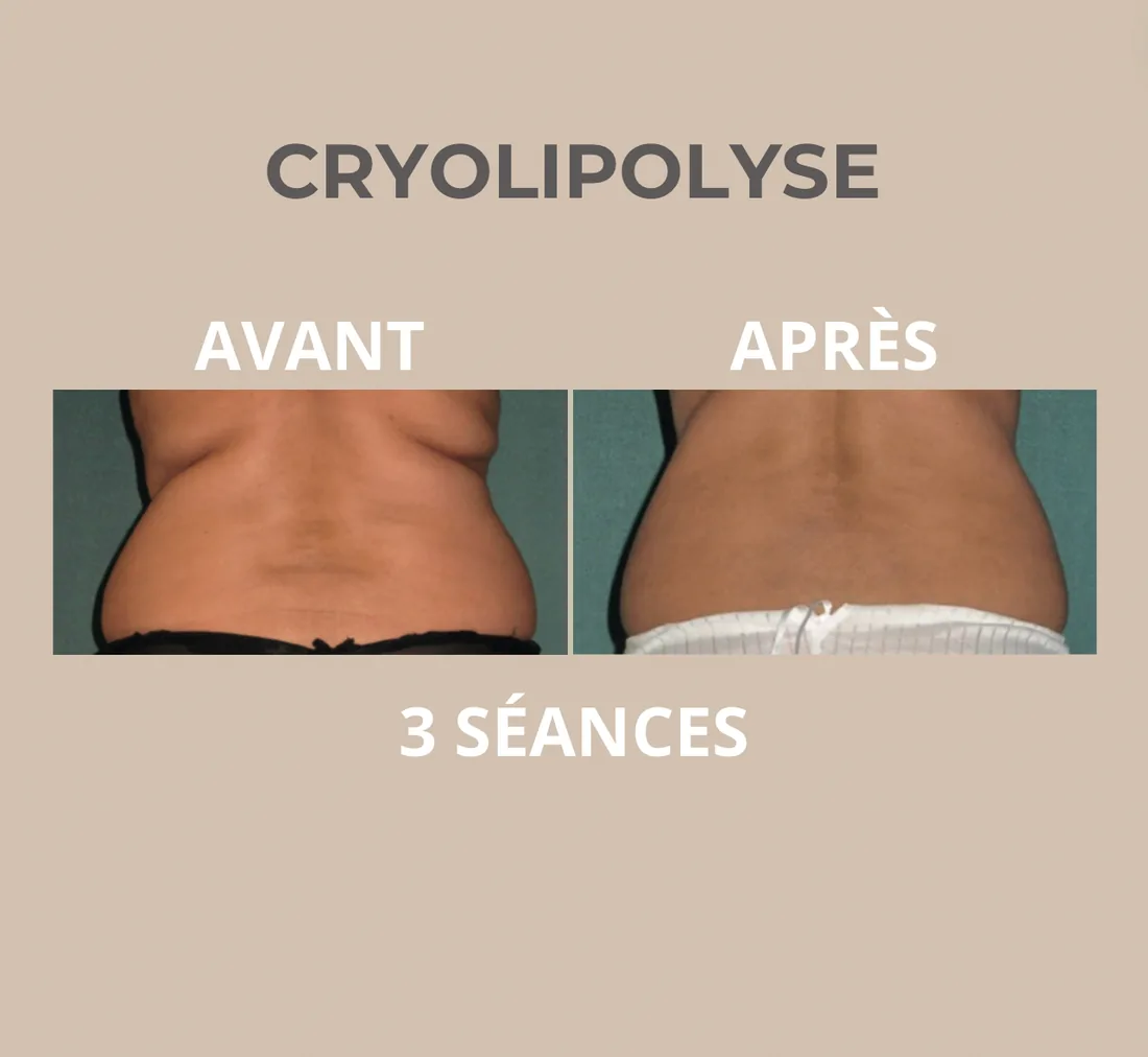 Cryolipolyse Périgueux — résultat avant / après sur 3 séances